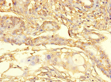 C13orf39 Antibody - Immunohistochemistry of paraffin-embedded human pancreatic cancer at dilution 1:100