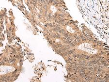 C13orf8 / ZNF828 Antibody - Immunohistochemistry of paraffin-embedded Human colorectal cancer tissue  using CHAMP1 Polyclonal Antibody at dilution of 1:40(×200)