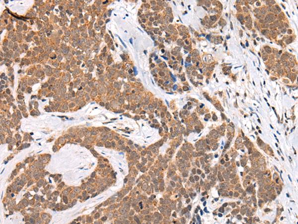C13orf8 / ZNF828 Antibody - Immunohistochemistry of paraffin-embedded Human thyroid cancer tissue  using CHAMP1 Polyclonal Antibody at dilution of 1:40(×200)