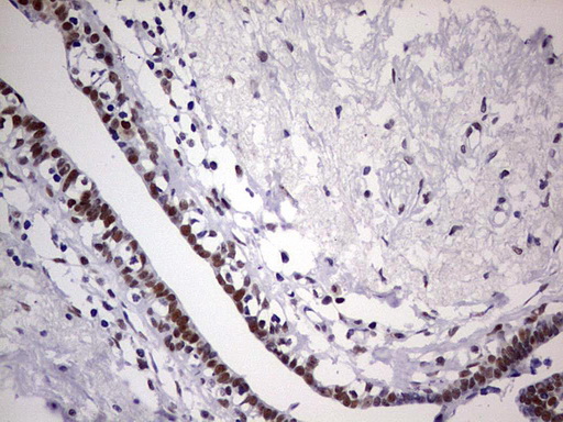 C14orf166 Antibody - IHC of paraffin-embedded Adenocarcinoma of Human breast tissue using anti-C14orf166 mouse monoclonal antibody. (Heat-induced epitope retrieval by 1 mM EDTA in 10mM Tris, pH8.5, 120°C for 3min).