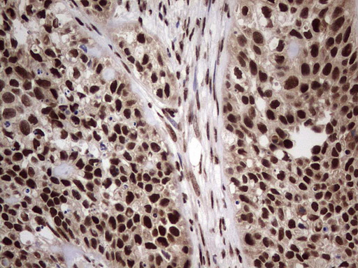 C14orf166 Antibody - IHC of paraffin-embedded Carcinoma of Human kidney tissue using anti-C14orf166 mouse monoclonal antibody. (Heat-induced epitope retrieval by 1 mM EDTA in 10mM Tris, pH8.5, 120°C for 3min).