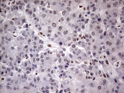 C14orf166 Antibody - IHC of paraffin-embedded Carcinoma of Human liver tissue using anti-C14orf166 mouse monoclonal antibody. (Heat-induced epitope retrieval by 1 mM EDTA in 10mM Tris, pH8.5, 120°C for 3min).