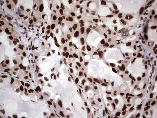 C14orf166 Antibody - IHC of paraffin-embedded Carcinoma of Human lung tissue using anti-C14orf166 mouse monoclonal antibody. (Heat-induced epitope retrieval by 1 mM EDTA in 10mM Tris, pH8.5, 120°C for 3min).