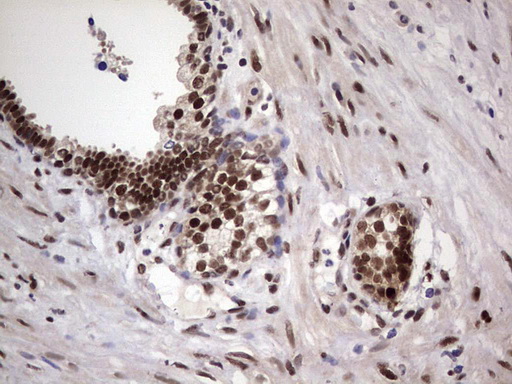 C14orf166 Antibody - IHC of paraffin-embedded Carcinoma of Human prostate tissue using anti-C14orf166 mouse monoclonal antibody. (Heat-induced epitope retrieval by 1 mM EDTA in 10mM Tris, pH8.5, 120°C for 3min).