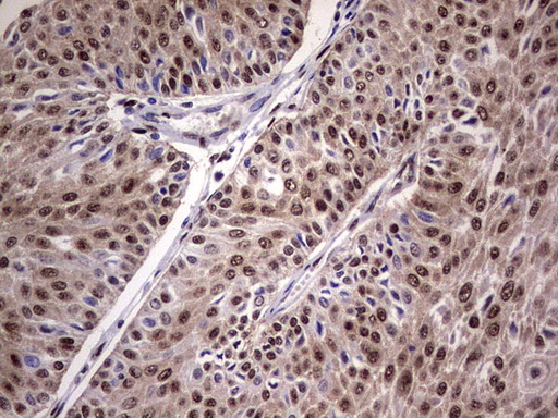 C14orf166 Antibody - IHC of paraffin-embedded Carcinoma of Human bladder tissue using anti-C14orf166 mouse monoclonal antibody. (Heat-induced epitope retrieval by 1 mM EDTA in 10mM Tris, pH8.5, 120°C for 3min).