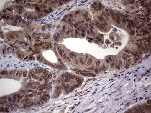 C14orf166 Antibody - IHC of paraffin-embedded Adenocarcinoma of Human colon tissue using anti-C14orf166 mouse monoclonal antibody. (Heat-induced epitope retrieval by 1 mM EDTA in 10mM Tris, pH8.5, 120°C for 3min).