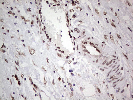 C14orf166 Antibody - IHC of paraffin-embedded Carcinoma of Human bladder tissue using anti-C14orf166 mouse monoclonal antibody. (Heat-induced epitope retrieval by 1 mM EDTA in 10mM Tris, pH8.5, 120°C for 3min).