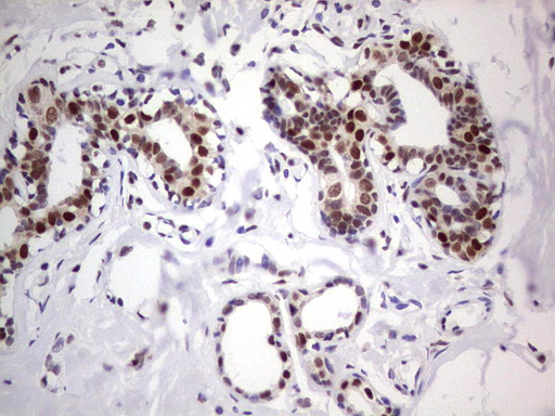 C14orf166 Antibody - IHC of paraffin-embedded Adenocarcinoma of Human breast tissue using anti-C14orf166 mouse monoclonal antibody. (Heat-induced epitope retrieval by 1 mM EDTA in 10mM Tris, pH8.5, 120°C for 3min).