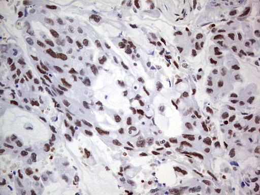 C14orf166 Antibody - IHC of paraffin-embedded Carcinoma of Human lung tissue using anti-C14orf166 mouse monoclonal antibody. (Heat-induced epitope retrieval by 1 mM EDTA in 10mM Tris, pH8.5, 120°C for 3min).