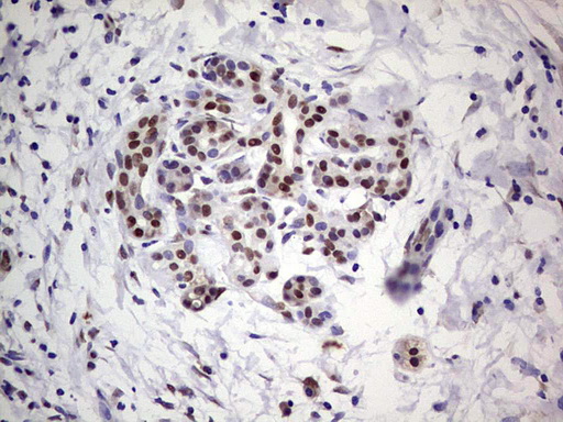 C14orf166 Antibody - IHC of paraffin-embedded Carcinoma of Human pancreas tissue using anti-C14orf166 mouse monoclonal antibody. (Heat-induced epitope retrieval by 1 mM EDTA in 10mM Tris, pH8.5, 120°C for 3min).