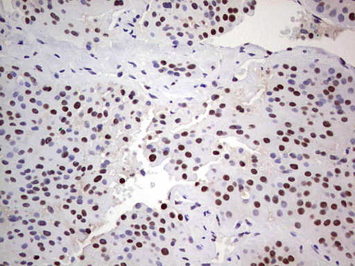 C14orf166 Antibody - IHC of paraffin-embedded Carcinoma of Human thyroid tissue using anti-C14orf166 mouse monoclonal antibody. (Heat-induced epitope retrieval by 1 mM EDTA in 10mM Tris, pH8.5, 120°C for 3min).