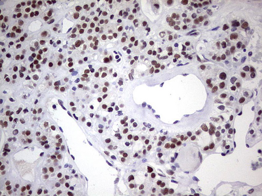 C14orf166 Antibody - IHC of paraffin-embedded Carcinoma of Human thyroid tissue using anti-C14orf166 mouse monoclonal antibody. (Heat-induced epitope retrieval by 1 mM EDTA in 10mM Tris, pH8.5, 120°C for 3min).