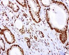 C14orf166 Antibody - Immunohistochemical staining of paraffin-embedded human colon cancer using anti-C14ORF166 clone UMAB181 mouse monoclonal antibody at 1:600 dilution of 1mg/mL and detection with Polink2 Broad HRP DAB.requires heat-induced epitope retrieval with Accel for 3minutes at110C in pressure chamber. The image shows the tumor cells have strong nuclear and weak cytoplasmic staining.