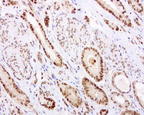 C14orf166 Antibody - Immunohistochemical staining of paraffin-embedded human colon cancer using anti-C14ORF166 clone UMAB182 mouse monoclonal antibody at 1:600 dilution of 1mg/mL and detection with Polink2 Broad HRP DAB.requires heat-induced epitope retrieval with Accel for 3minutes at110C in pressure chamber. The image shows the tumor cells have strong nuclear and weak cytoplasmic staining.