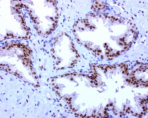 C14orf166 Antibody - Immunohistochemical staining of paraffin-embedded human prostate cancer using anti-C14ORF166 clone UMAB182 mouse monoclonal antibody at 1:600 dilution of 1mg/mL and detection with Polink2 Broad HRP DAB.requires heat-induced epitope retrieval with Accel for 3minutes at110C in pressure chamber. The image shows the tumor cells have strong nuclear and intermediate levels of cytoplasmic staining.