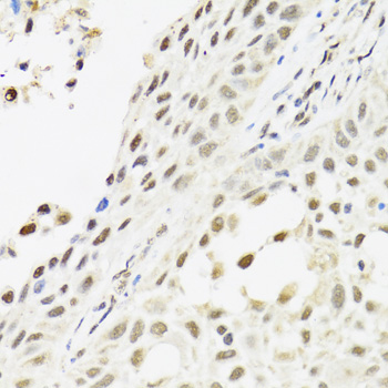 C14orf166 Antibody - Immunohistochemistry of paraffin-embedded human lung cancer tissue.