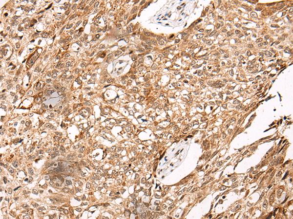 C14orf169 / NO66 Antibody - Immunohistochemistry of paraffin-embedded Human lung cancer tissue  using C14orf169 Polyclonal Antibody at dilution of 1:45(×200)