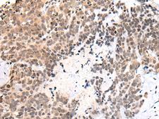C14orf169 / NO66 Antibody - Immunohistochemistry of paraffin-embedded Human thyroid cancer tissue  using C14orf169 Polyclonal Antibody at dilution of 1:45(×200)