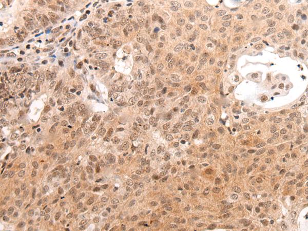 C14orf169 / NO66 Antibody - Immunohistochemistry of paraffin-embedded Human ovarian cancer tissue  using C14orf169 Polyclonal Antibody at dilution of 1:45(×200)