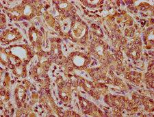 C14orf177 Antibody - Immunohistochemistry Dilution at 1:200 and staining in paraffin-embedded human liver cancer performed on a Leica BondTM system. After dewaxing and hydration, antigen retrieval was mediated by high pressure in a citrate buffer (pH 6.0). Section was blocked with 10% normal Goat serum 30min at RT. Then primary antibody (1% BSA) was incubated at 4°C overnight. The primary is detected by a biotinylated Secondary antibody and visualized using an HRP conjugated SP system.