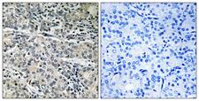 C14orf2 Antibody - Immunohistochemistry analysis of paraffin-embedded human prostate carcinoma tissue, using MP68 Antibody. The picture on the right is blocked with the synthesized peptide.