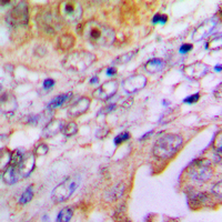 C14orf2 Antibody - Immunohistochemical analysis of MP68 staining in human lung cancer formalin fixed paraffin embedded tissue section. The section was pre-treated using heat mediated antigen retrieval with sodium citrate buffer (pH 6.0). The section was then incubated with the antibody at room temperature and detected using an HRP conjugated compact polymer system. DAB was used as the chromogen. The section was then counterstained with hematoxylin and mounted with DPX.