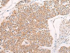 C14orf2 Antibody - Immunohistochemistry of paraffin-embedded Human prost at e cancer tissue  using C14orf2 Polyclonal Antibody at dilution of 1:60(×200)