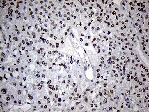 C14orf80 Antibody - Immunohistochemical staining of paraffin-embedded Carcinoma of Human kidney tissue using anti-C14orf80 mouse monoclonal antibody. (Heat-induced epitope retrieval by 1mM EDTA in 10mM Tris buffer. (pH8.5) at 120°C for 3 min. (1:250)