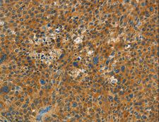 C15orf2 Antibody - Immunohistochemistry of paraffin-embedded Human thyroid cancer using NPAP1 Polyclonal Antibody at dilution of 1:60.