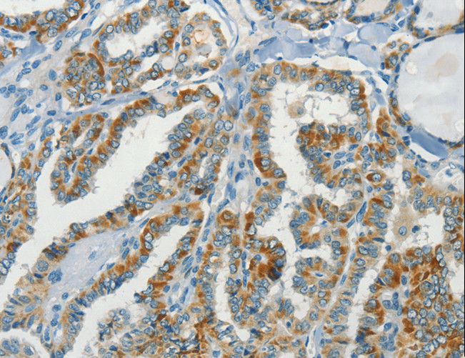 C15orf2 Antibody - Immunohistochemistry of paraffin-embedded Human thyroid cancer using NPAP1 Polyclonal Antibody at dilution of 1:70.