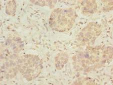 C15orf40 Antibody - Immunohistochemistry of paraffin-embedded human gastric cancer using antibody at dilution of 1:100.
