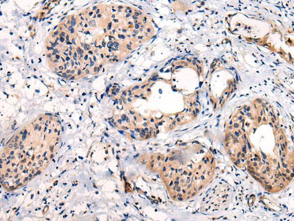 C16orf45 Antibody - Immunohistochemistry of paraffin-embedded Human cervical cancer tissue  using C16orf45 Polyclonal Antibody at dilution of 1:45(×200)