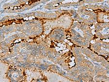 C16orf48 Antibody - Immunohistochemistry of paraffin-embedded Human thyroid cancer tissue  using ENKD1 Polyclonal Antibody at dilution of 1:75(×200)