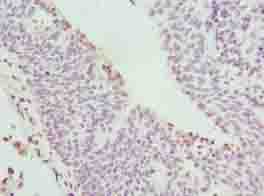 C17orf62 Antibody - Immunohistochemistry of paraffin-embedded human bladder carcinoma using antibody at dilution of 1:100.