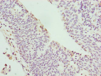 C17orf62 Antibody - Immunohistochemistry of paraffin-embedded human bladder cancer using CYBC1 Antibody at dilution of 1:100