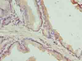 C17orf64 Antibody - Immunohistochemistry of paraffin-embedded human prostate cancer using antibody at dilution of 1:100.