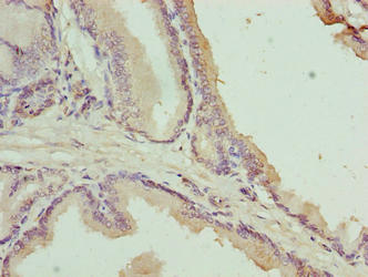 C17orf64 Antibody - Immunohistochemistry of paraffin-embedded human prostate cancer using C17orf64 Antibody at dilution of 1:100