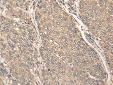 C17orf67 Antibody - Immunohistochemistry of paraffin-embedded Human liver cancer tissue  using C17orf67 Polyclonal Antibody at dilution of 1:50(×200)