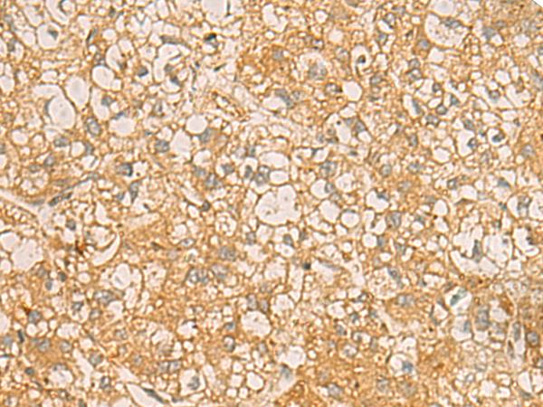 C17orf70 Antibody - Immunohistochemistry of paraffin-embedded Human liver cancer tissue  using FAAP100 Polyclonal Antibody at dilution of 1:50(×200)