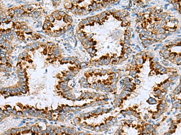 C17orf70 Antibody - Immunohistochemistry of paraffin-embedded Human lung cancer tissue  using FAAP100 Polyclonal Antibody at dilution of 1:85(×200)