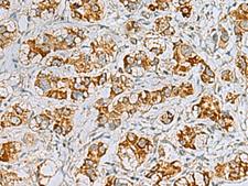 C17orf70 Antibody - Immunohistochemistry of paraffin-embedded Human liver cancer tissue  using FAAP100 Polyclonal Antibody at dilution of 1:40(×200)