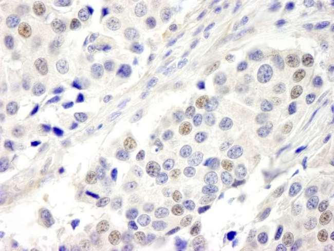 C17orf71 Antibody - Detection of Human ABC2 by Immunohistochemistry. Sample: FFPE section of human breast carcinoma. Antibody: Affinity purified rabbit anti-ABC2 used at a dilution of 1:250.