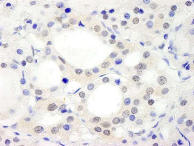 C17orf71 Antibody - Detection of Human ABC2 by Immunohistochemistry. Sample: FFPE section of human thyroid carcinoma. Antibody: Affinity purified rabbit anti-ABC2 used at a dilution of 1:250.