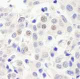 C17orf71 Antibody - Detection of Human ABC2 by Immunohistochemistry. Sample: FFPE section of human breast carcinoma. Antibody: Affinity purified rabbit anti-ABC2 used at a dilution of 1:1000 (1 ug/ml).