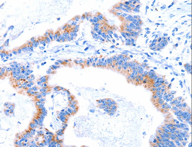 C17orf71 Antibody - Immunohistochemistry of paraffin-embedded Human lung cancer using SMG8 Polyclonal Antibody at dilution of 1:50.