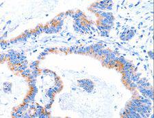 C17orf71 Antibody - Immunohistochemistry of paraffin-embedded Human lung cancer using SMG8 Polyclonal Antibody at dilution of 1:50.
