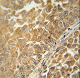 C18orf25 / ARKL1 Antibody - CR025 antibody immunohistochemistry of formalin-fixed and paraffin-embedded human bladder carcinoma followed by peroxidase-conjugated secondary antibody and DAB staining.