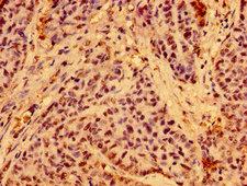 C19orf12 Antibody - Immunohistochemistry image of paraffin-embedded human ovarian cancer at a dilution of 1:100