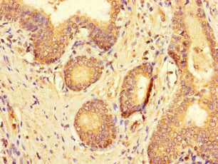 C19orf44 Antibody - Immunohistochemistry of paraffin-embedded human prostate cancer using C19orf44 Antibody at dilution of 1:100