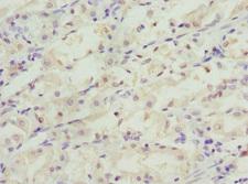 C1GALT1C1 Antibody - Immunohistochemistry of paraffin-embedded human gastric cancer at dilution 1:100
